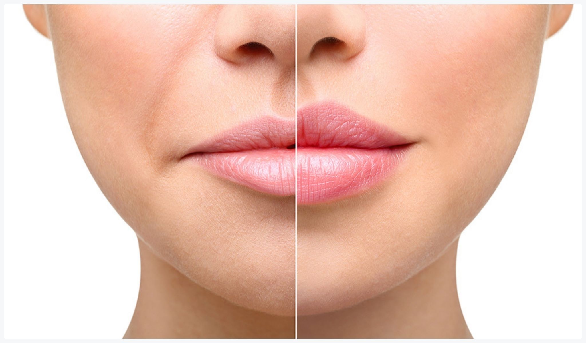 Cosmetic_Dermal_Fillers