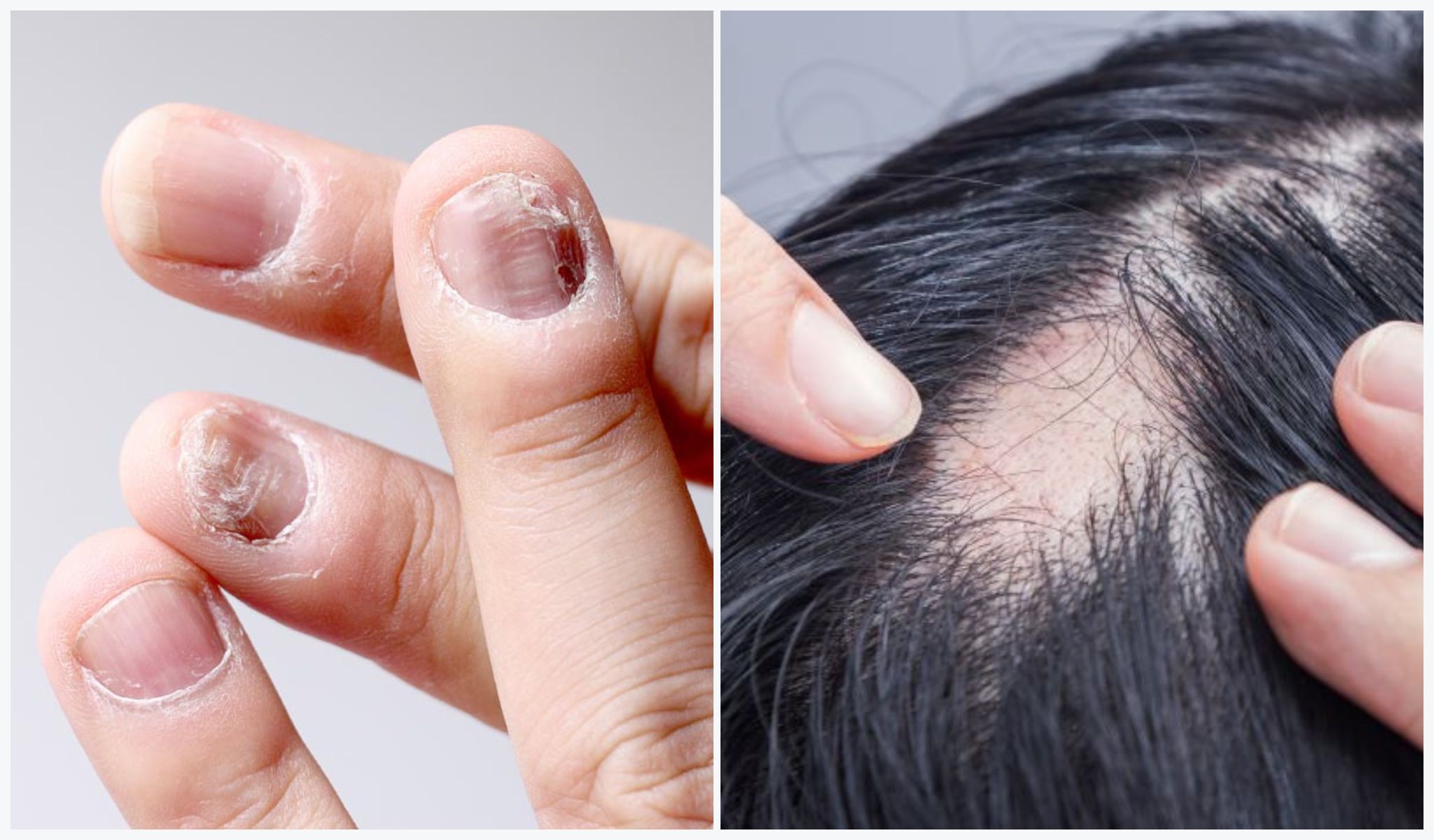 Hair & Nail Diseases