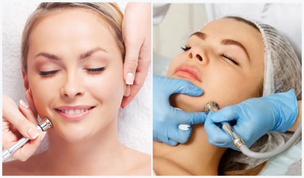 Microdermabrasion