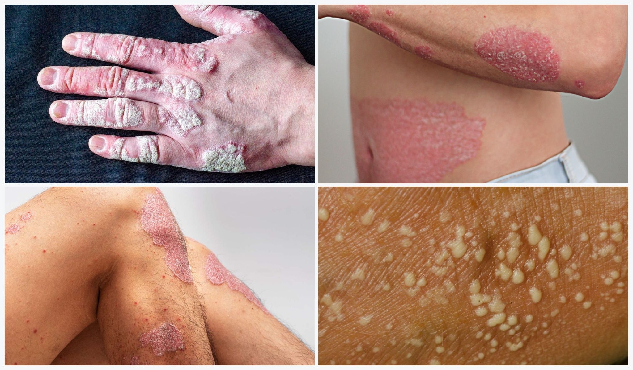 PSORIASIS Management