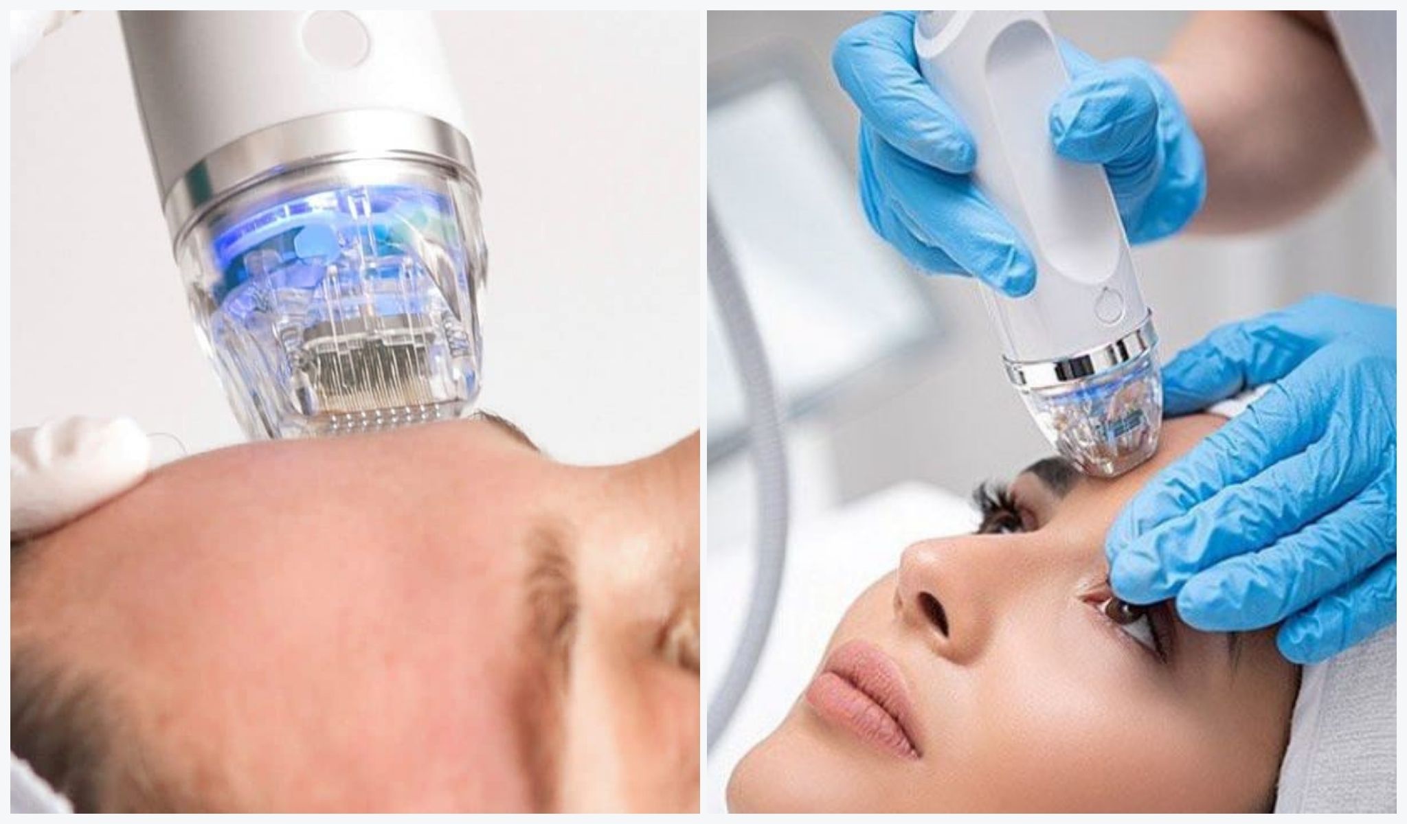 RF_Microneedling