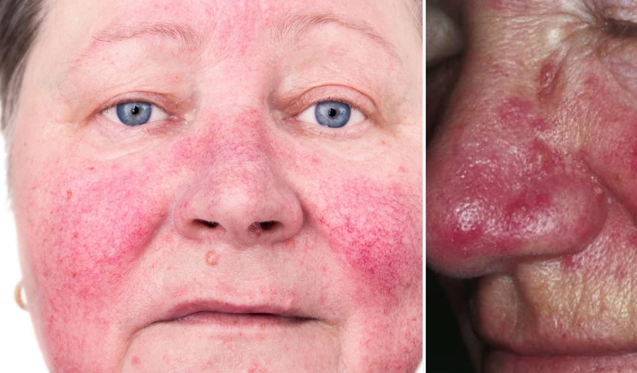 ROSACEA